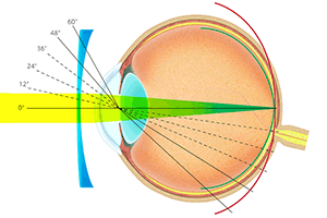 メガネレンズによる矯正時の網膜への像の結び方