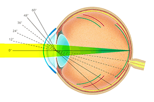 オルソによる矯正時の網膜への像の結び方