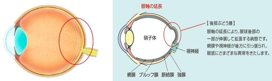 眼軸の延長