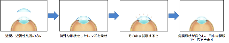 オルソケラトロジーの使用法